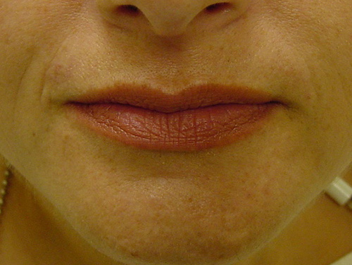 Facial Filler Treatment Before Facial Filler Treatment Before