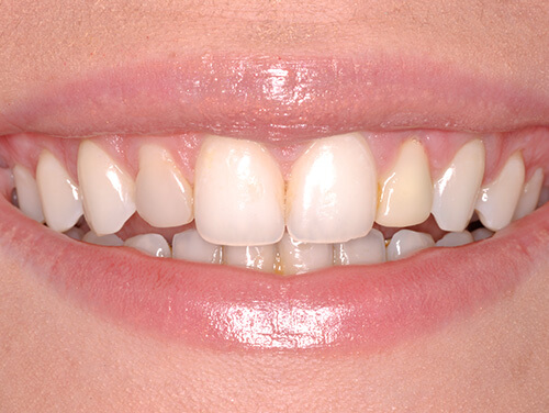 Same Day Dental Implants After Same Day Dental Implants After