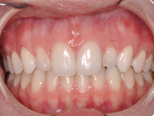Same Day Dental Implants Before Same Day Dental Implants Before