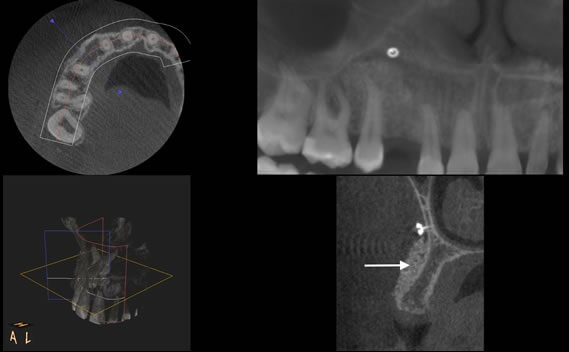 Missing Tooth Replacement After