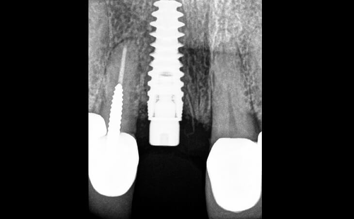 Broken Front Tooth Treatment After
