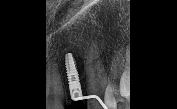 Congenitally Missing Lateral Teeth Treatment After