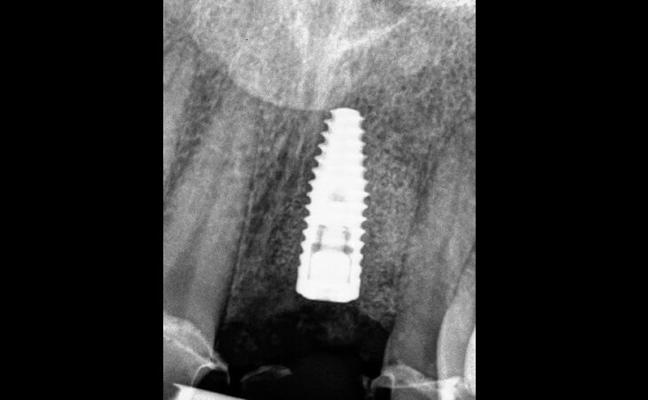 Missing Front Tooth Replacement After