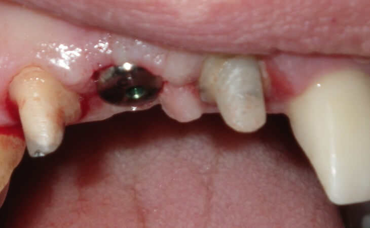 Bone Defect & Missing Tooth Treatment After