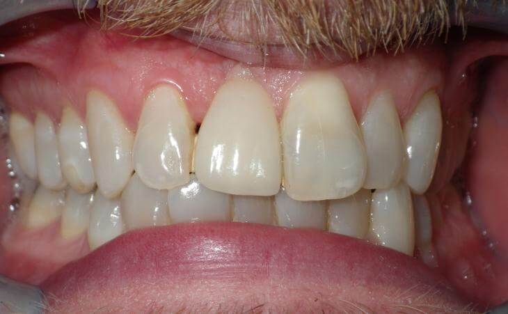 Single Tooth Replacement After