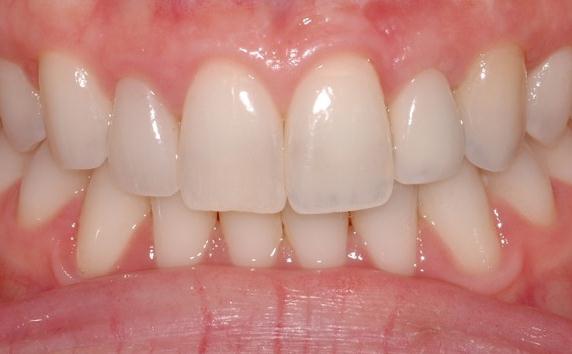 Bone Graft For Missing Teeth After