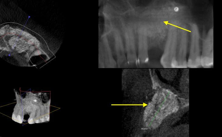 Bone Regeneration And Cyst Removal After 