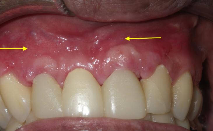 Ridge Defect After