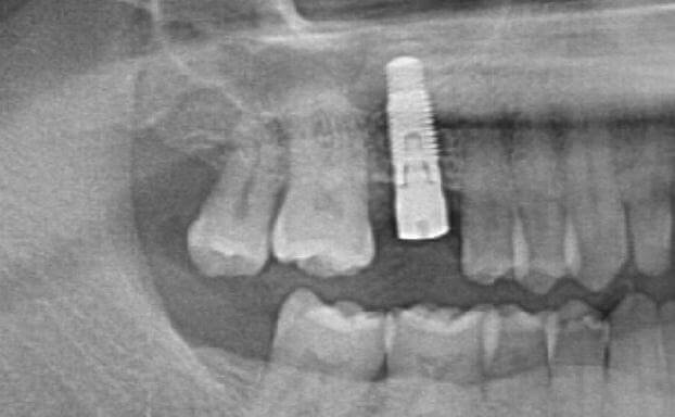 Internal Sinus Lift After