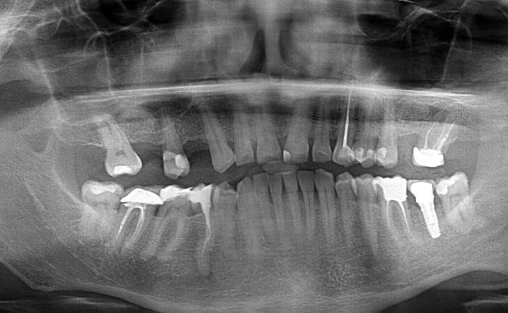 Bilateral Sinus Lift Surgery After