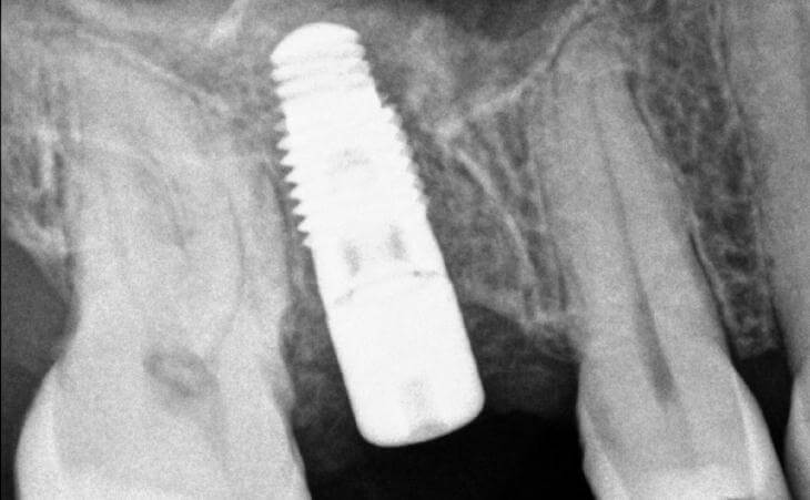 Internal Sinus Lift And Implant Placement After