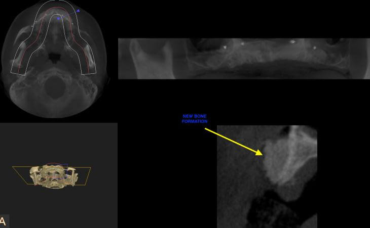 Severe Upper Jaw Bone Loss Treatment After