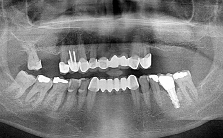 Bilateral Sinus Lift Treatment After