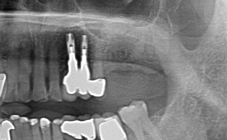 Left Upper Jaw Sinus Lift After
