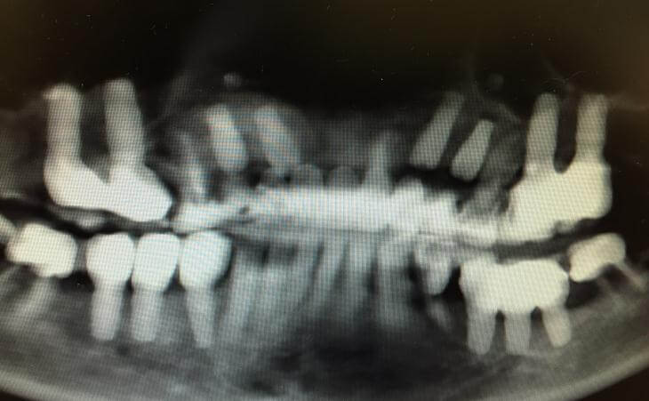 Bone Grafting For Tooth Replacement After