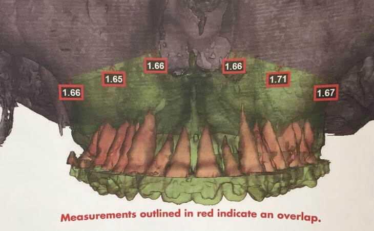 Virtual Planning To Ensure Correct Surgery