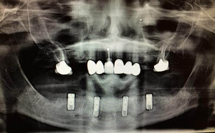 4 Implant OverDenture After