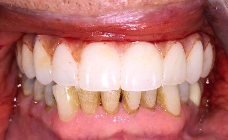 Guided Implant Surgery Tooth Replacement After