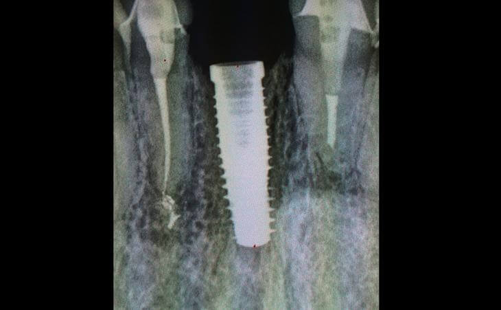 Planned Implant Position Result