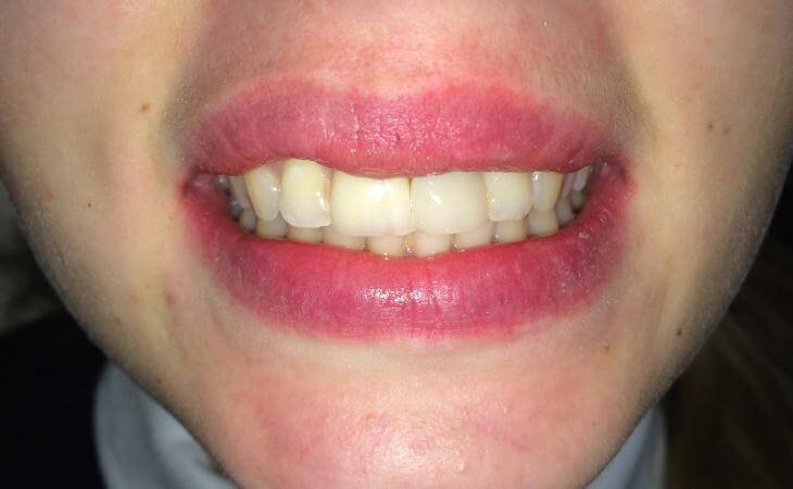 Immediate Dental Implant For Broken Tooth After