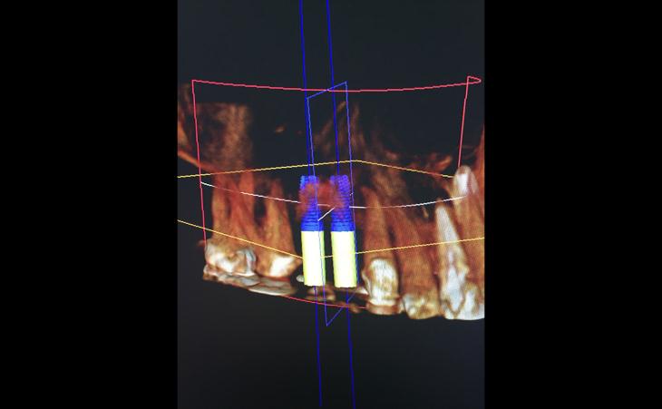 Guided Implant Placement After