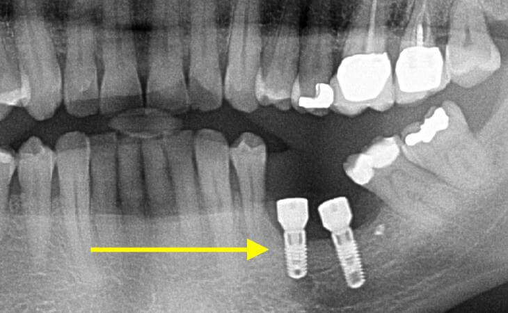 Thin Ridge Treatment After