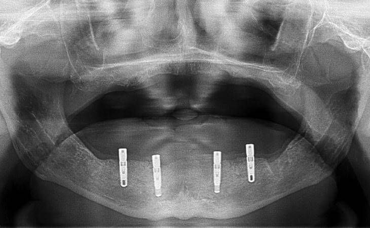 Implant-Supported Denture After