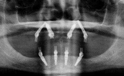 Complete Jaw Bone Regeneration After