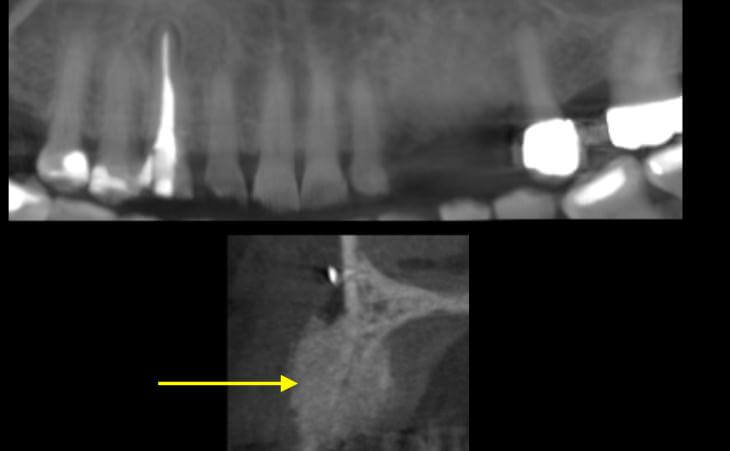 Resorbed Ridge Treatment After