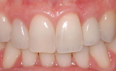 Missing Lateral Teeth Replacement After