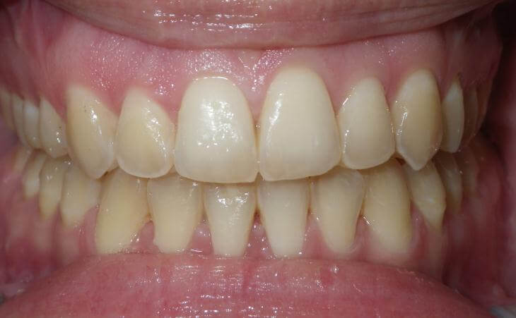 Open Bite Treatment After