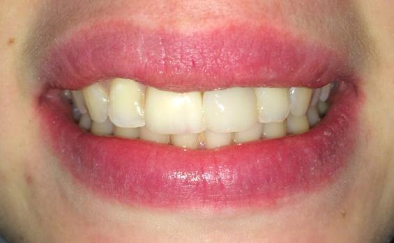 Broken Front Tooth Replacement After