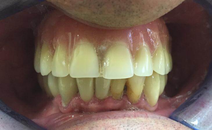 Missing Upper Teeth Treatment After