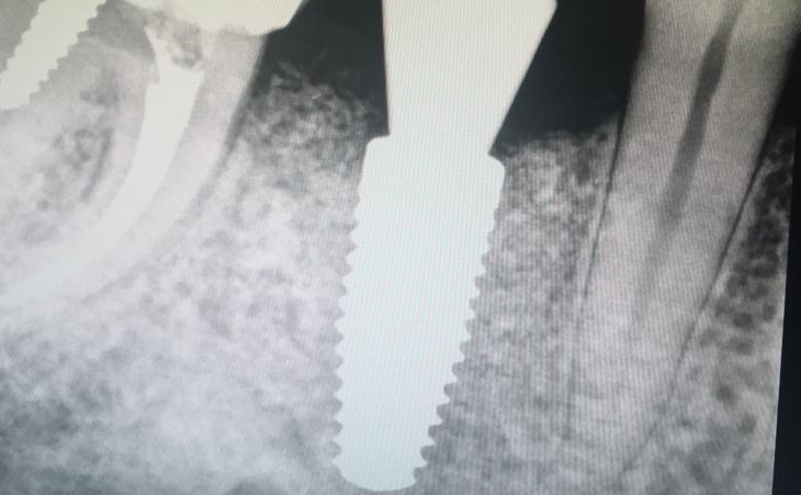 Replacing A Failed Implant Placed By A General Dentist After