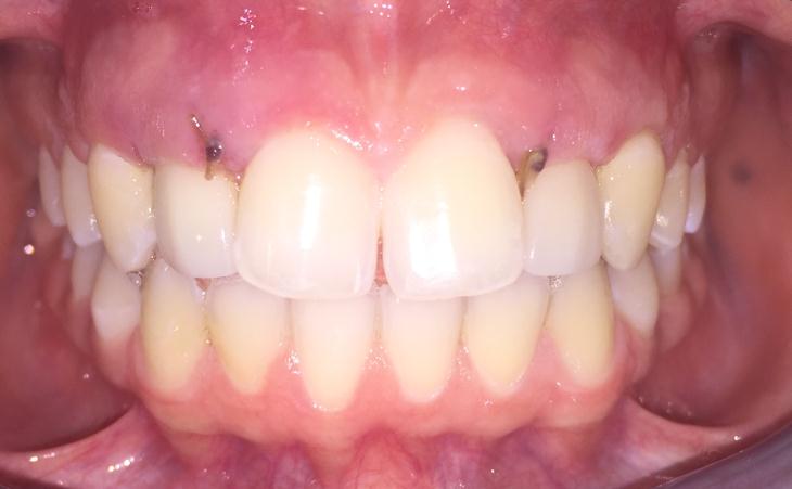 Replacing Missing Lateral Teeth Since Birth After