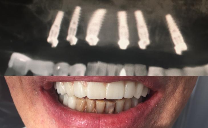 After 6 implants and Immediate placement of Teeth