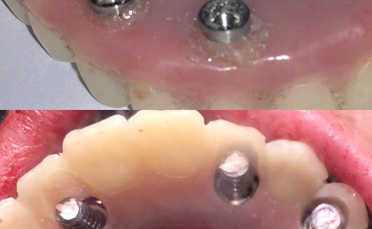 Guided Implant Surgery Of Upper And Lower Jaw After