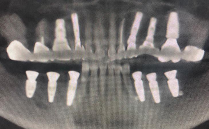 Replacing Multiple Teeth After