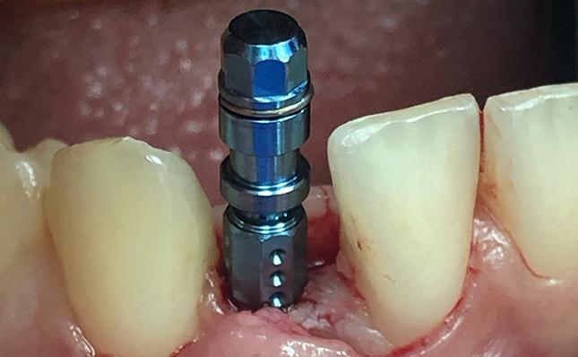 Replacing Single Tooth With Guided Implant Surgery After