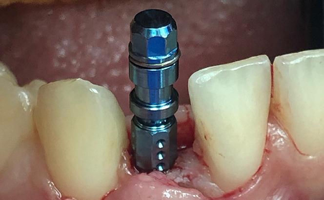 Replacing Single Tooth With Guided Implant Surgery After
