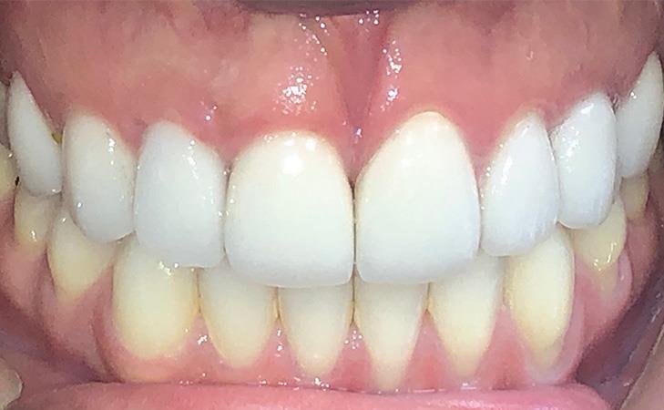 Replacing Baby Teeth With Immediate Implants After