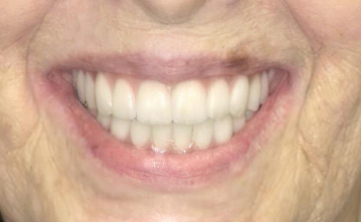 After All-on-6 Dental Implants 