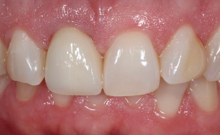 Front Tooth with Implant After