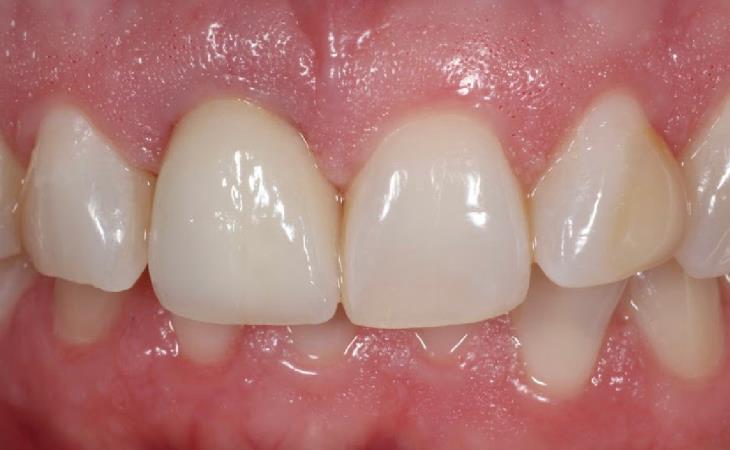 After - Front Tooth with Implant