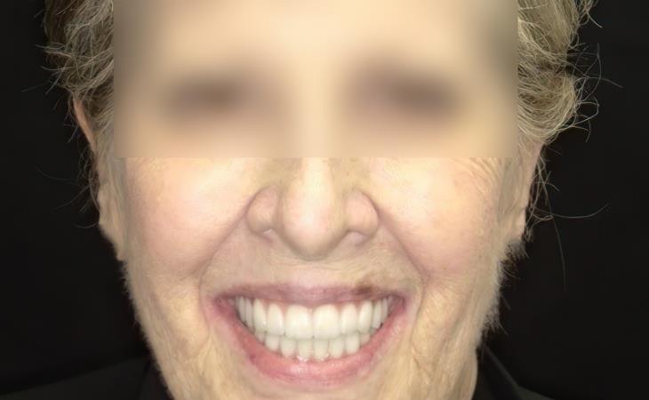 After Result Immediate Dental Implants