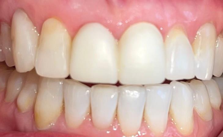 Front Tooth with Implant After