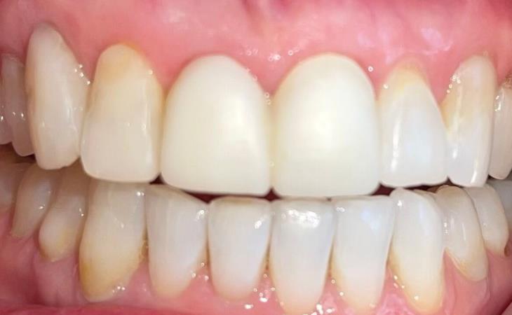 Missing Front Tooth with Dental Implant