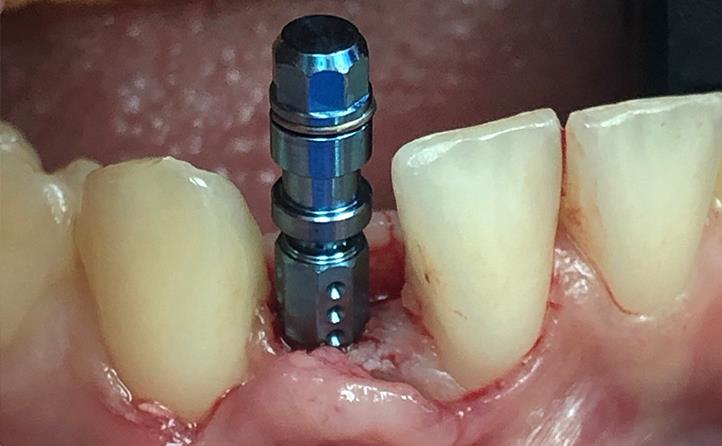 Replacing Single Tooth With Guided Implant Surgery After