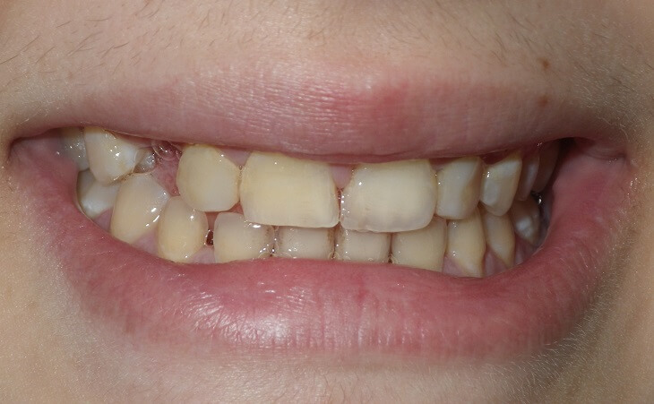 Missing Tooth Replacement Before