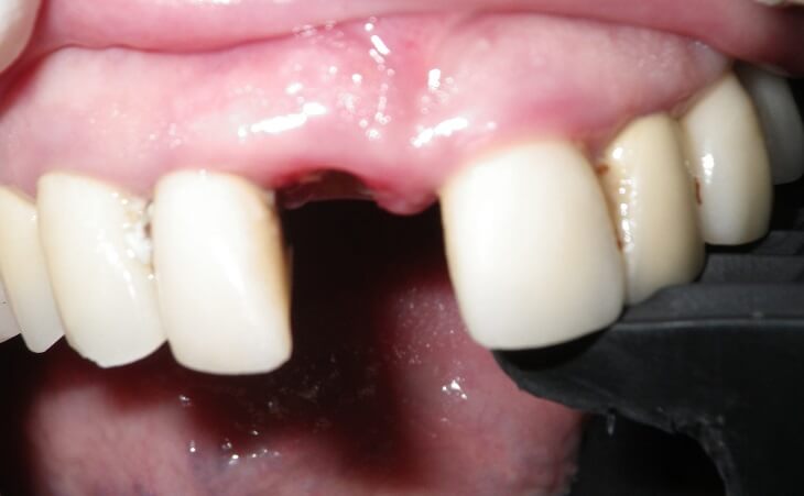 Broken Front Tooth Treatment Before
